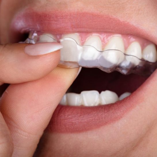 close-up of a person putting an Invisalign aligner in their mouth 