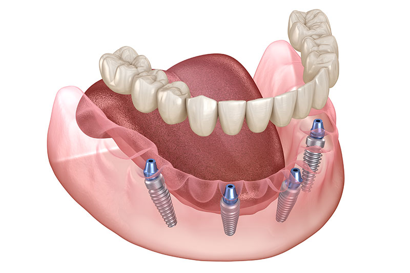 All on 4 Dental Implants in Grove City