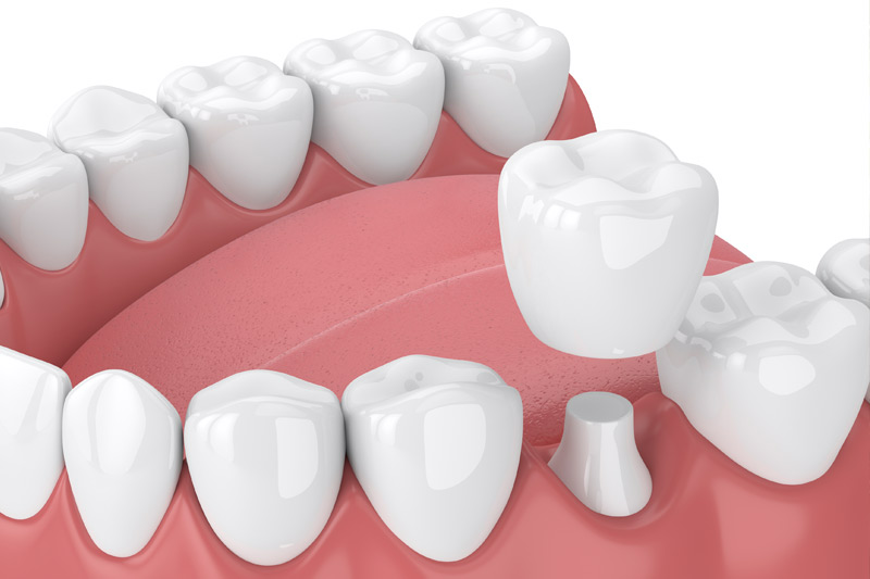 Dental Crowns in Grove City