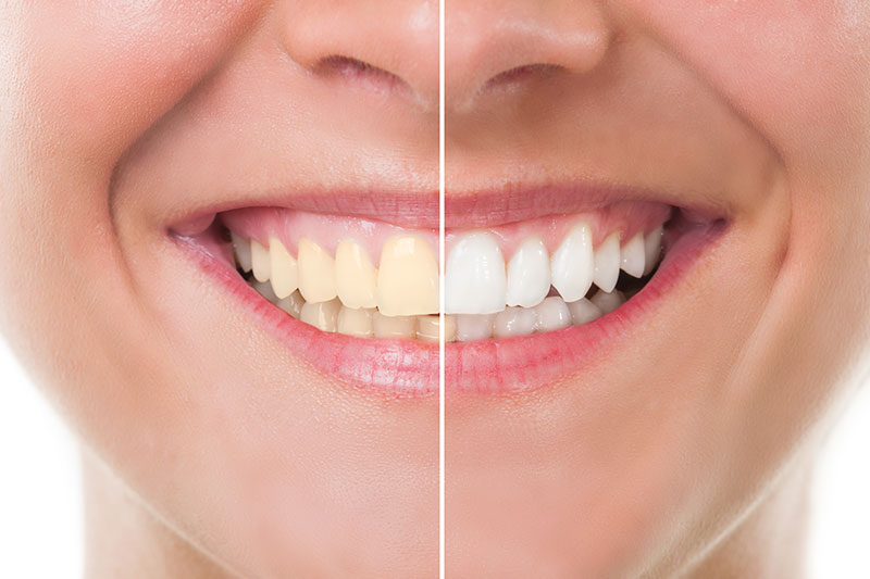 Teeth Whitening in Grove City