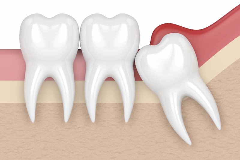 Wisdom Tooth Removal in Grove City